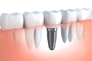 Dental implants at Seidler Family Dentistry